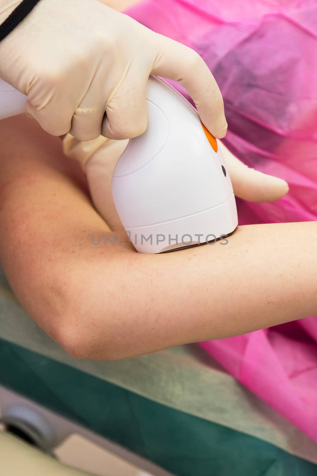 Laser epilation or photo epilation of woman hand