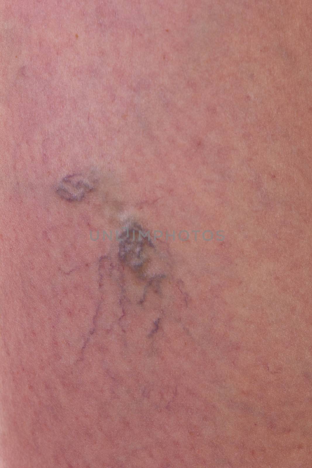 Close-up of skin with varicose veins by gwolters