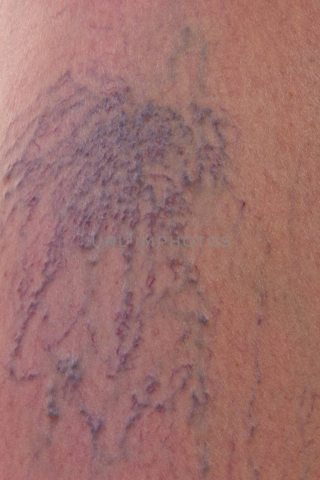 Close-up of dermis with varicose veins by gwolters