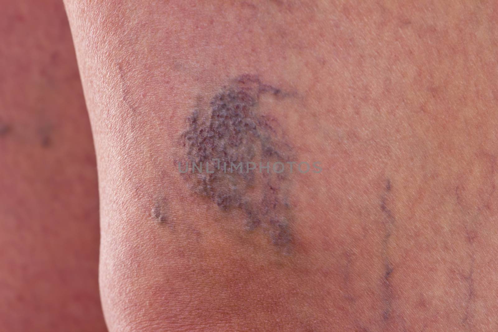 Close-up of legs with varicose veins by gwolters