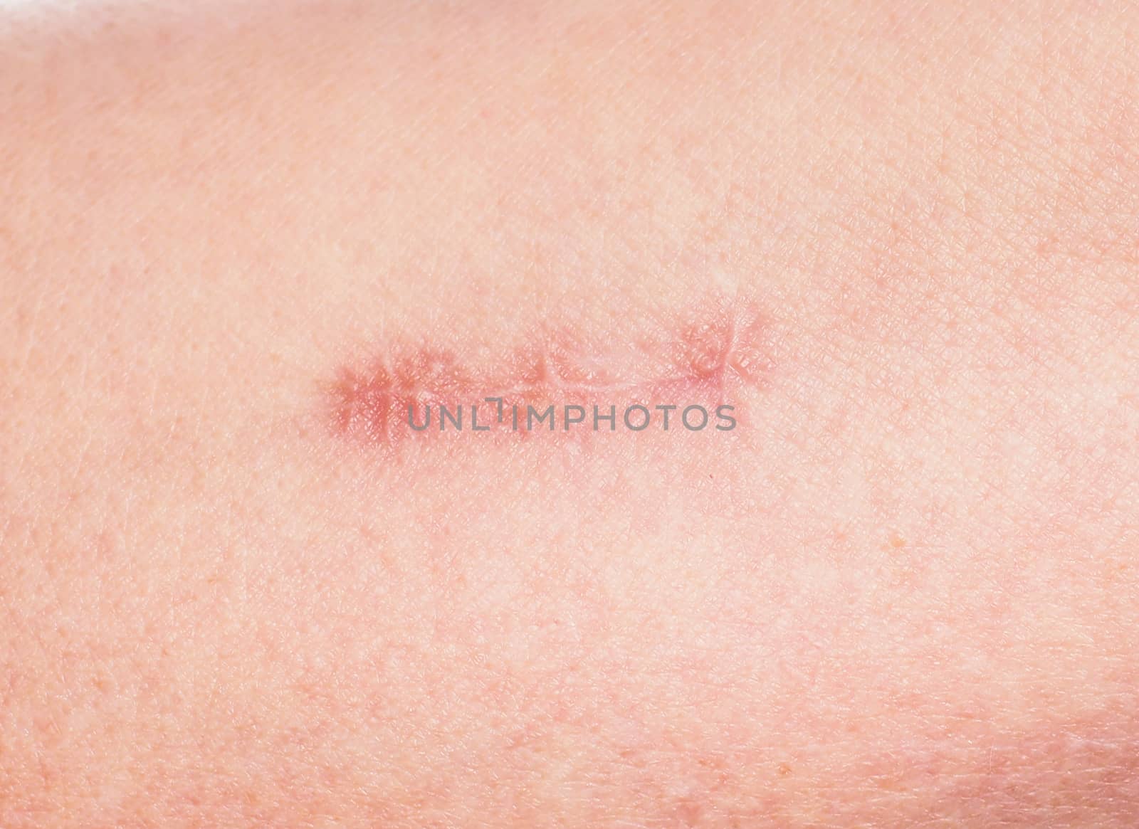 Redness around healing stitches on skin by Arvebettum