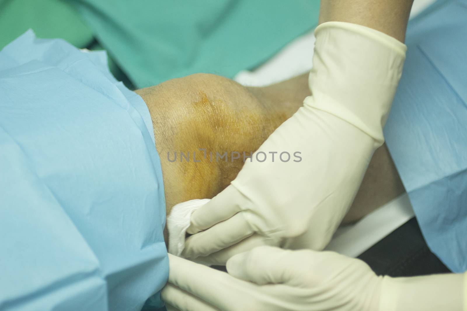 Close-up color photo of a female hospital clinic nurse wearing sterile blue gloves and senior male patient aged 65-70 being cleaned after receiving a an injection of human growth factors in his knee with sterilising liquid covering skin and sterile green hospital bed defocused background.