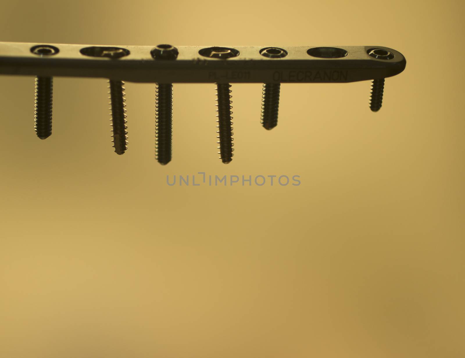 Traumatology orthopedic surgery implant plate and screws by edwardolive