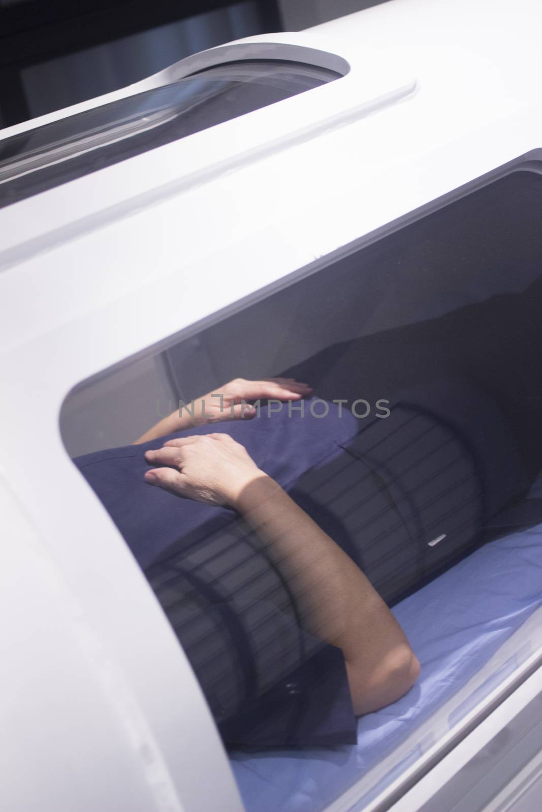 Female patient aged 45-55 wearing flower dress lying down in hyperbaric oxygen chamber receiving Hyperbaric Oxygen Therapy (HBOT) specialised medical treatment for injuries.