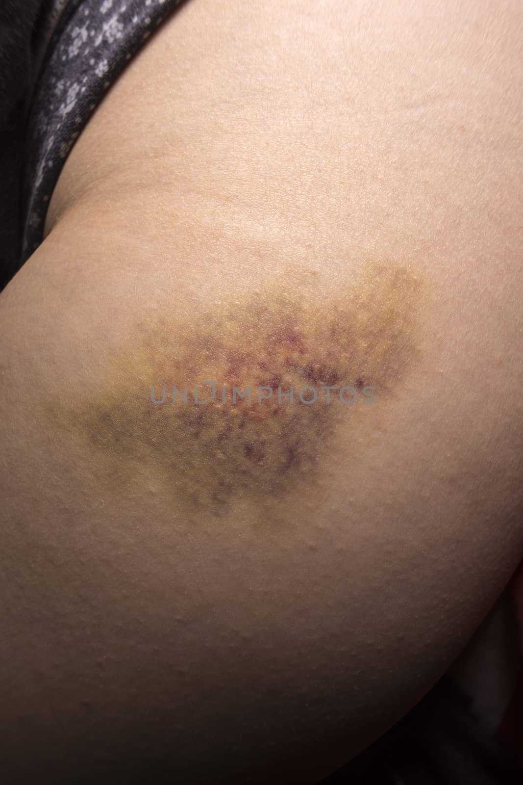 Closeup on a Bruise on wounded woman leg.