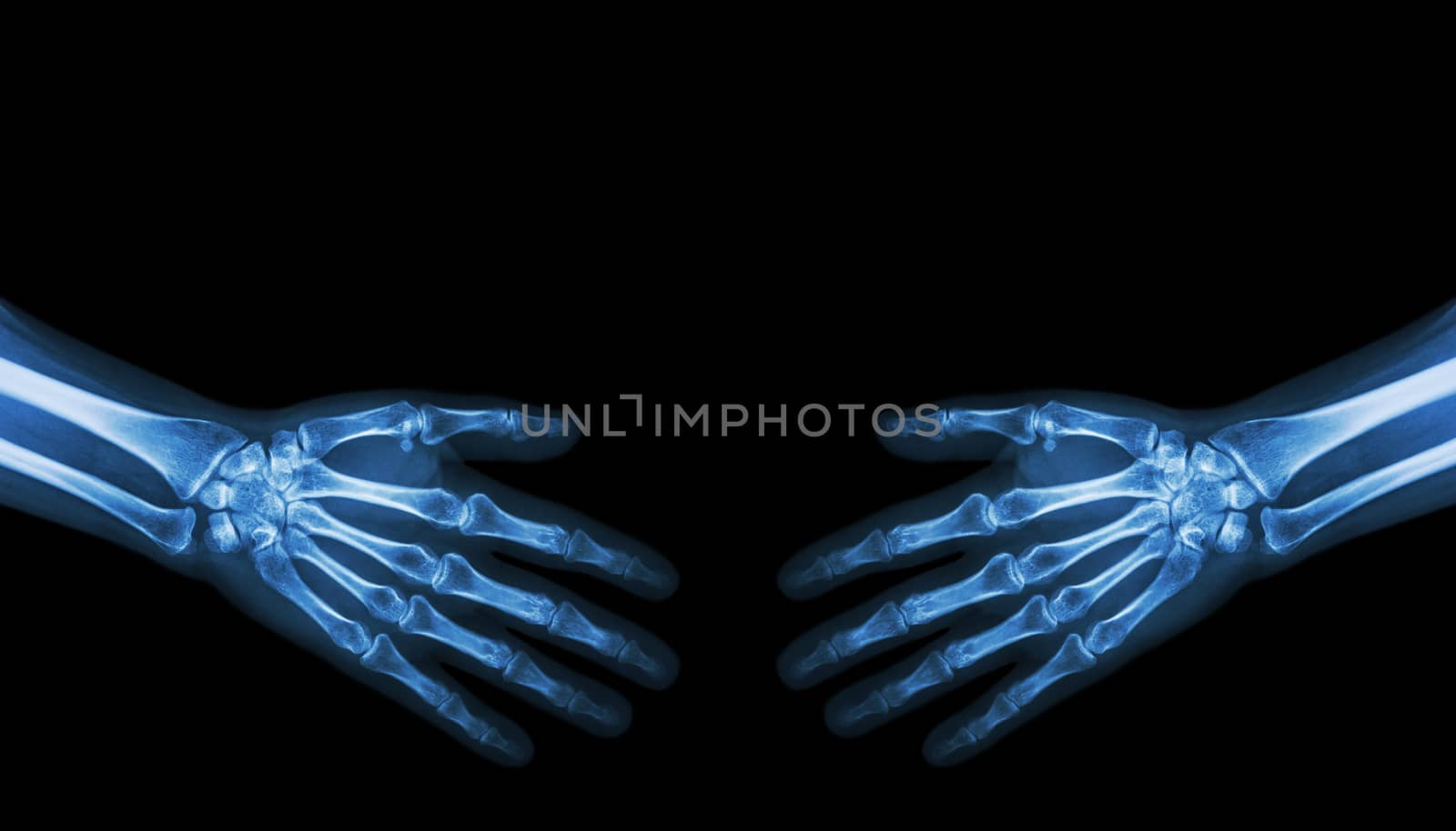 Shake hands . X-ray normal human hands ( blank area at upper side )