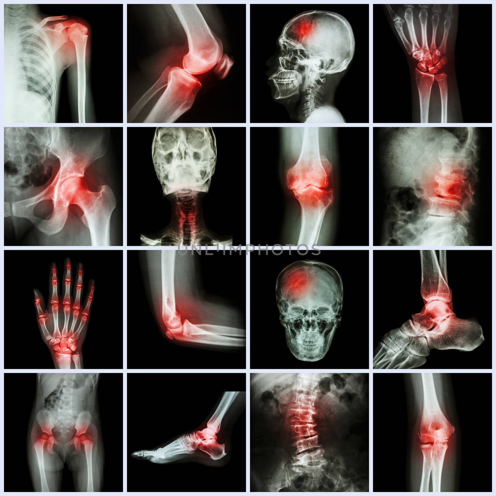 Collection human joint and arthritis and stroke by stockdevil
