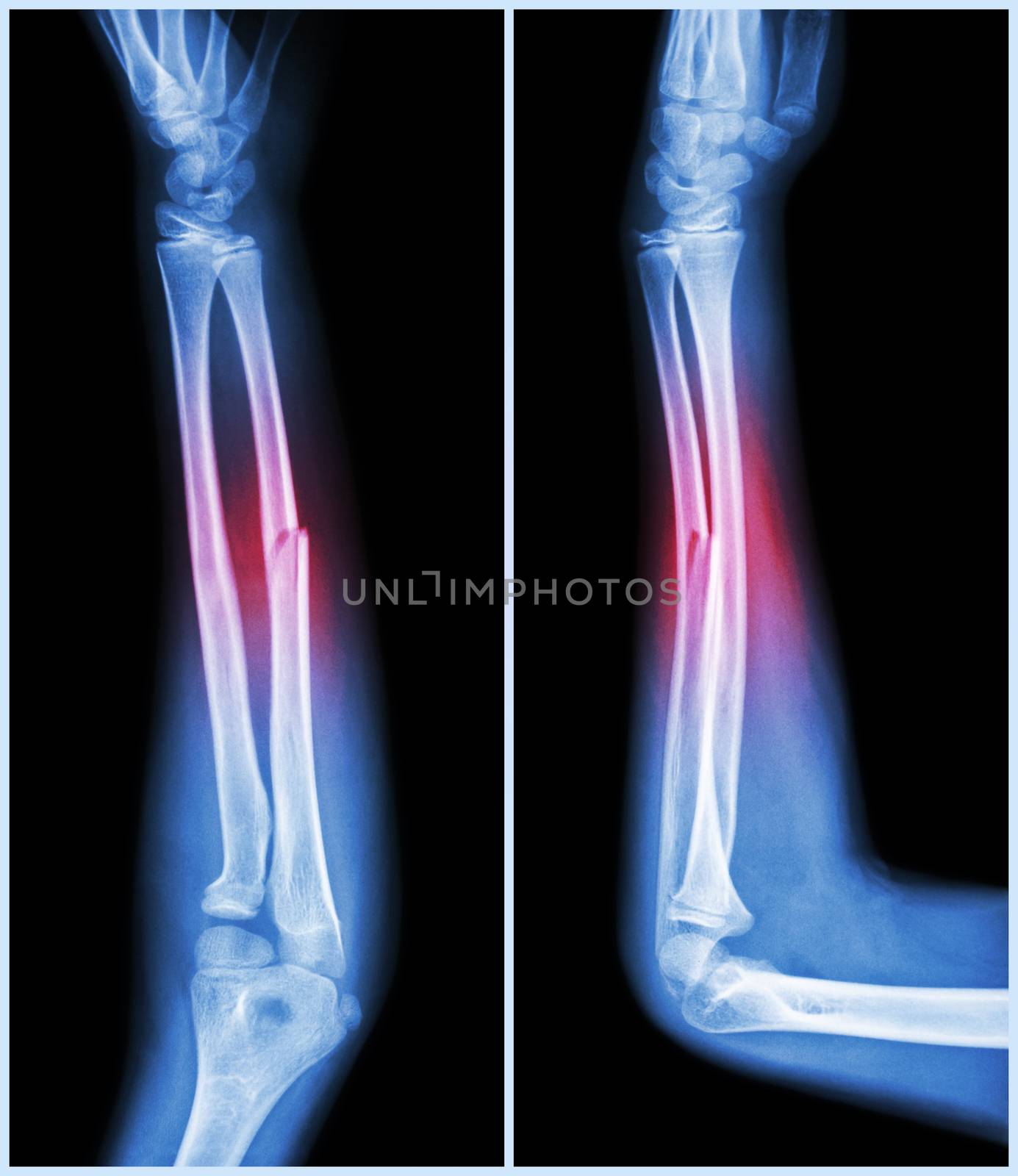 Fracture shaft of ulnar bone ( forearm bone ) : ( front and side view ) by stockdevil