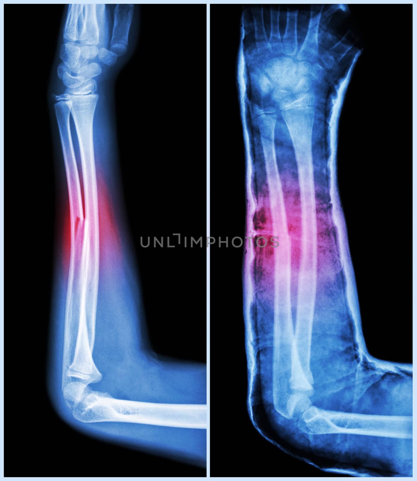 Fracture shaft of ulnar bone ( forearm bone ) : ( Left : pre-treatment , Right : Psot-treatment (splint with cast) ) by stockdevil