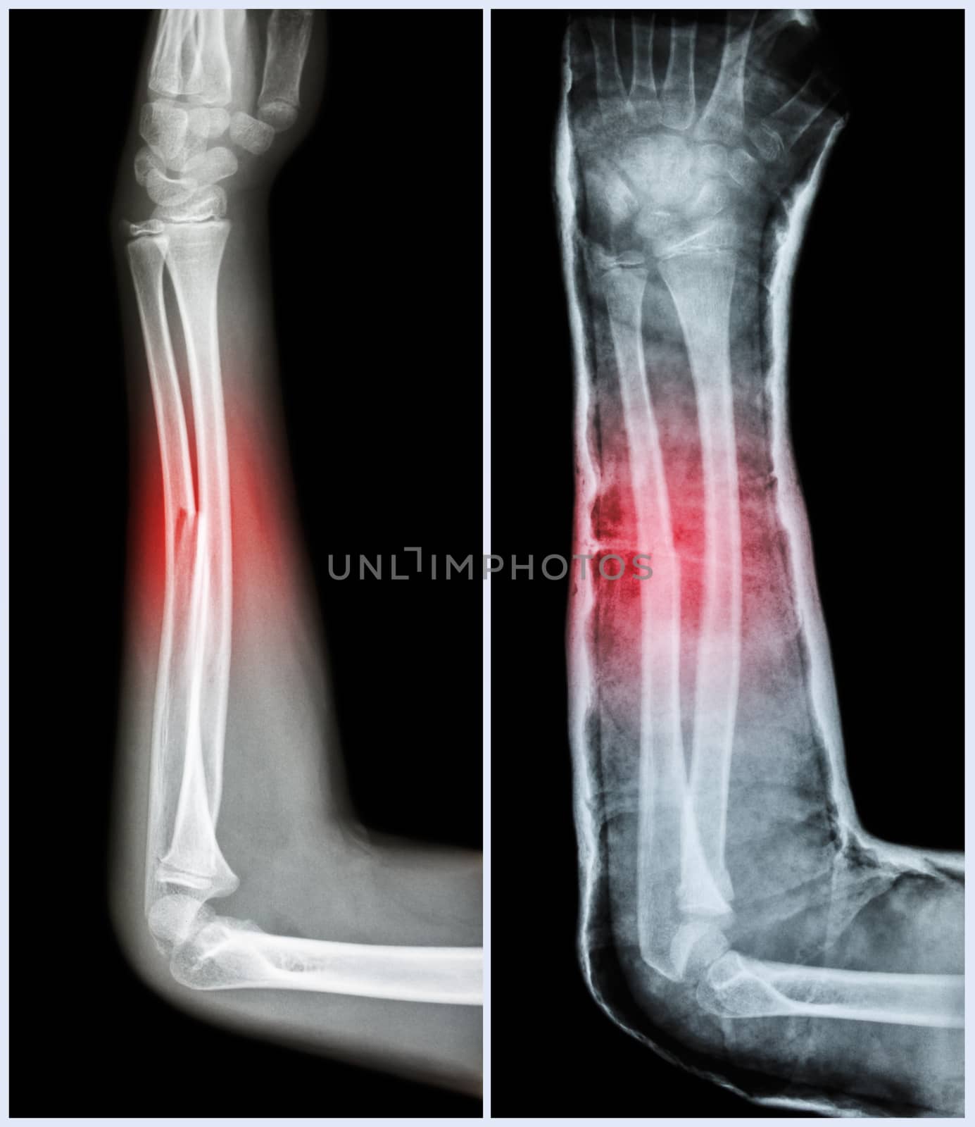 Fracture shaft of ulnar bone ( forearm bone ) : ( Left : pre-treatment , Right : Psot-treatment (splint with cast) ) by stockdevil