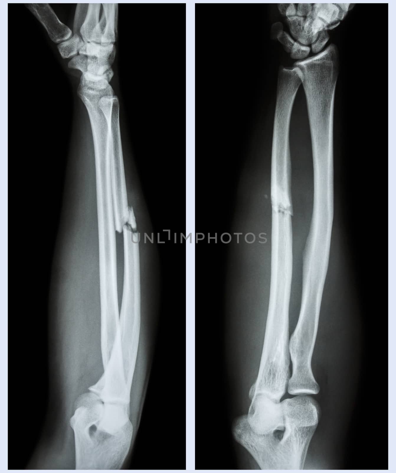 X-ray forearm ( front , side ) : Comminuted fracture shaft of ulnar bone ( forearm bone )