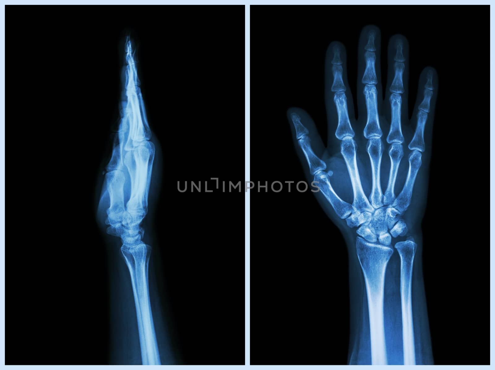 X-Ray Hands ( front & side view ) : Normal human hands by stockdevil