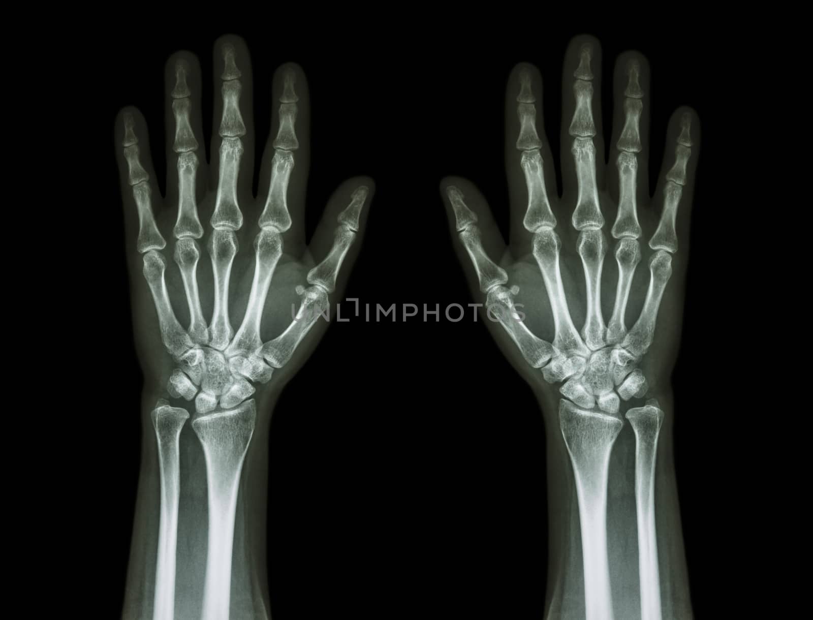 X-Ray Hands ( front view ) : Normal human hands by stockdevil