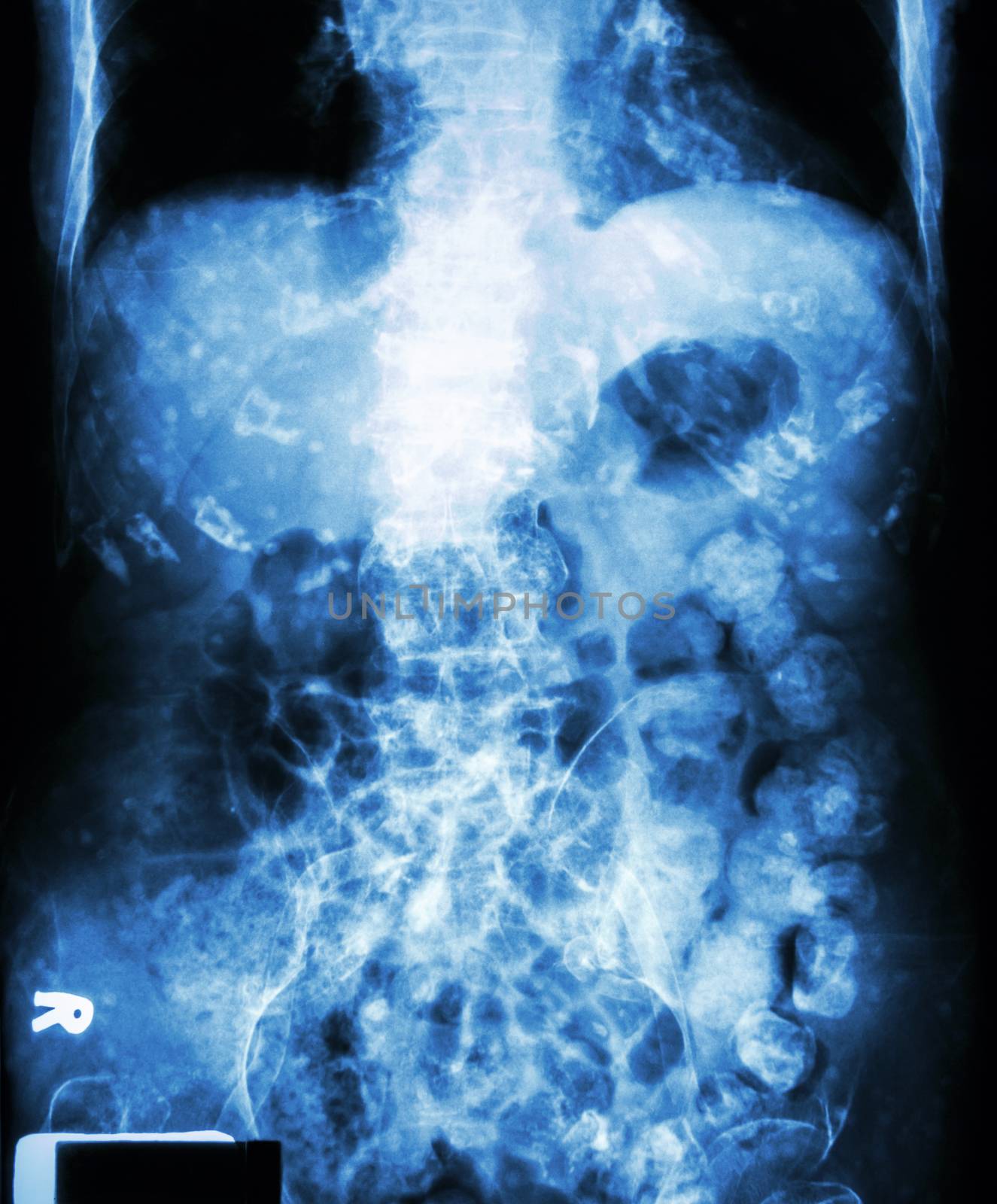 " Constipation " ( X-ray abdomen of old man : a lot of feces in large bowel and calcified at rib )