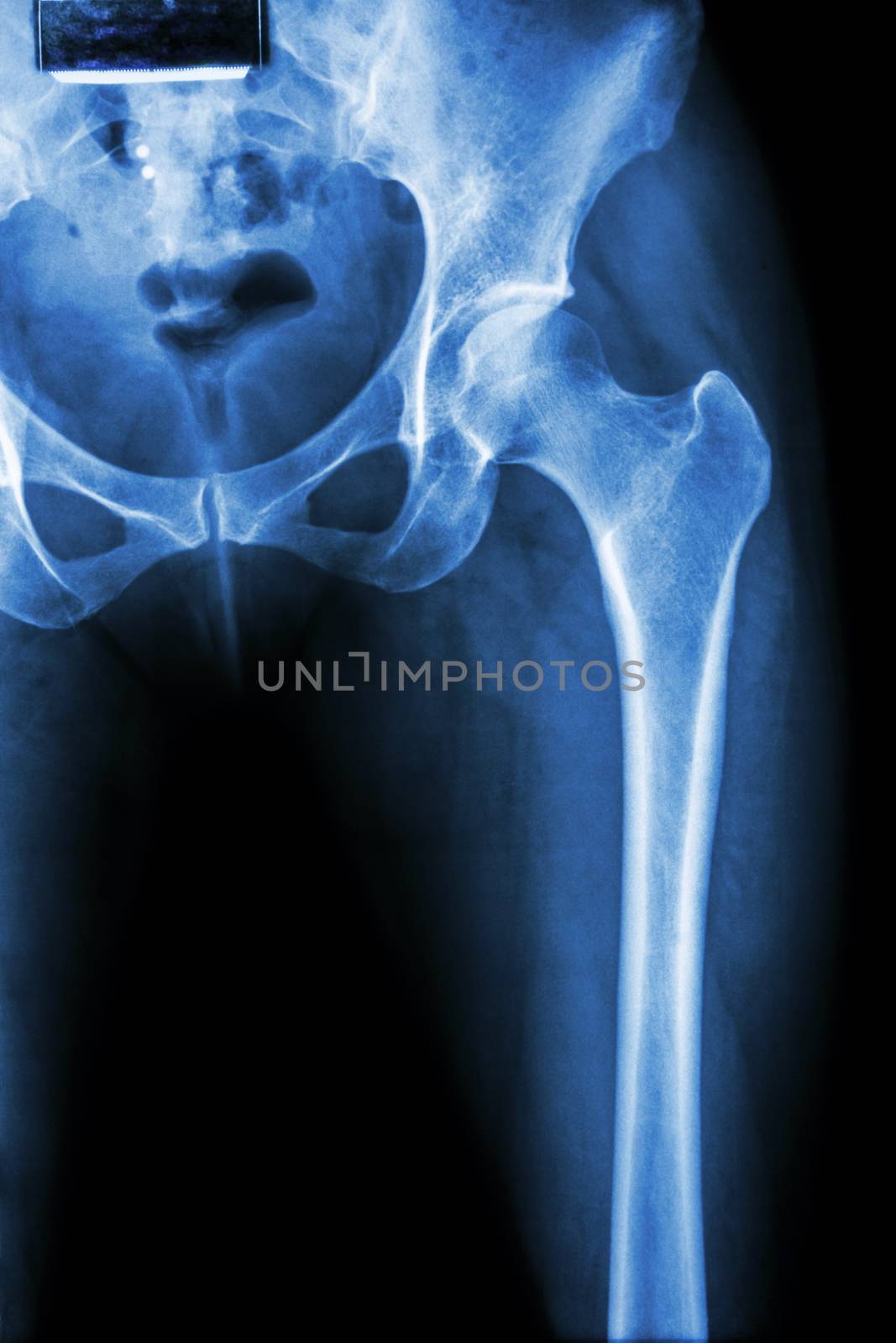 normal pelvis & hip joint by stockdevil