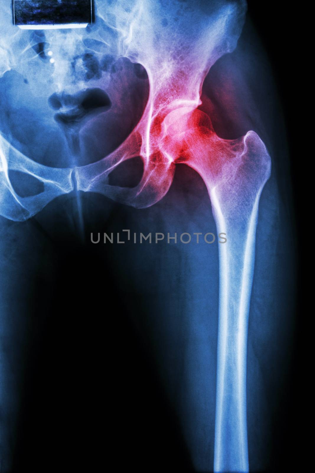 Arthritis at hip joint by stockdevil