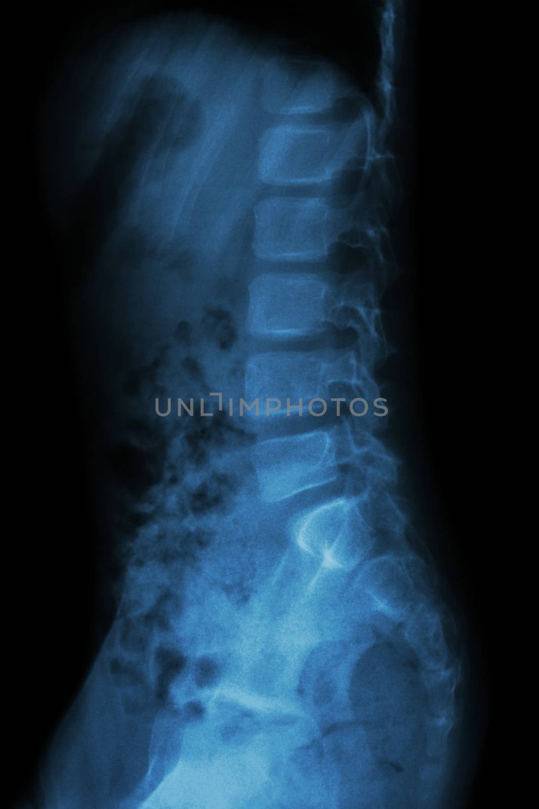Lumbar spine of child by stockdevil