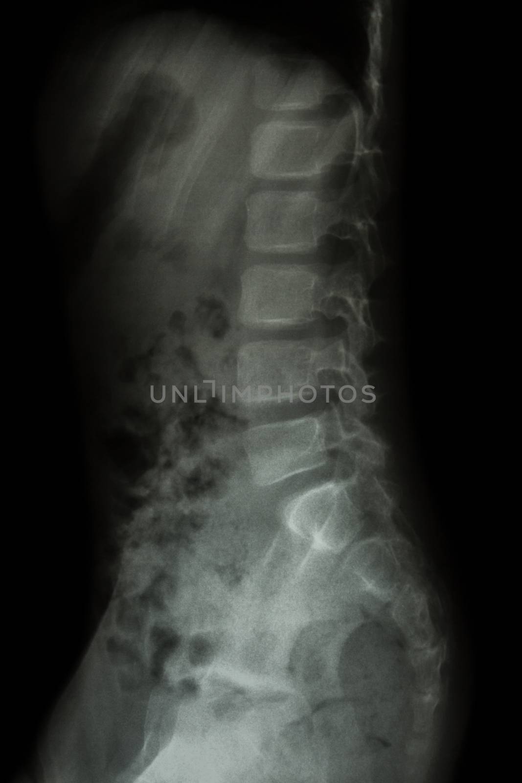 Lumbar spine of child ( X-ray thoracic - lumbar spine ) ( latera by stockdevil