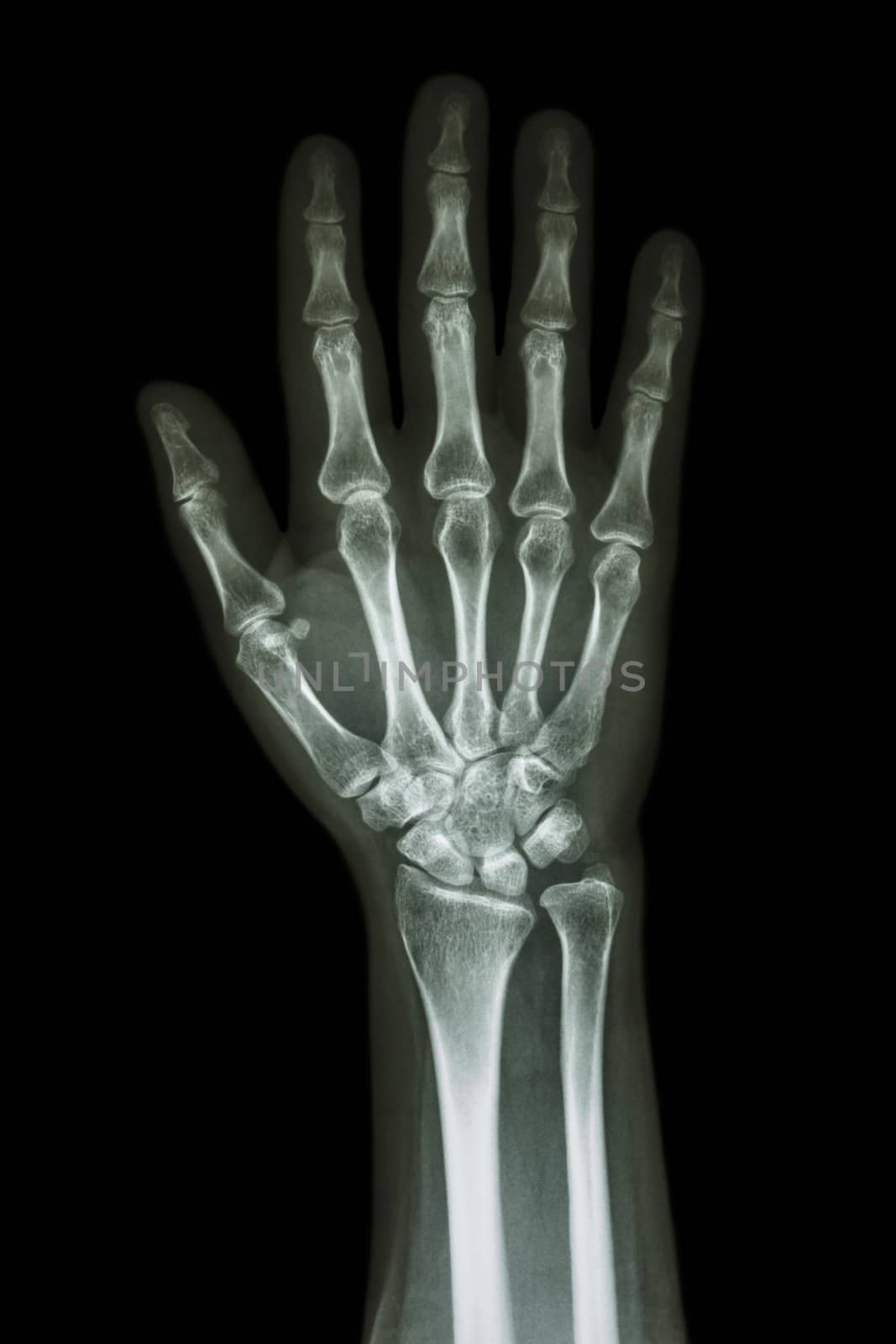 X-ray hand & forearm AP ( anterior-posterior ) ( front view )