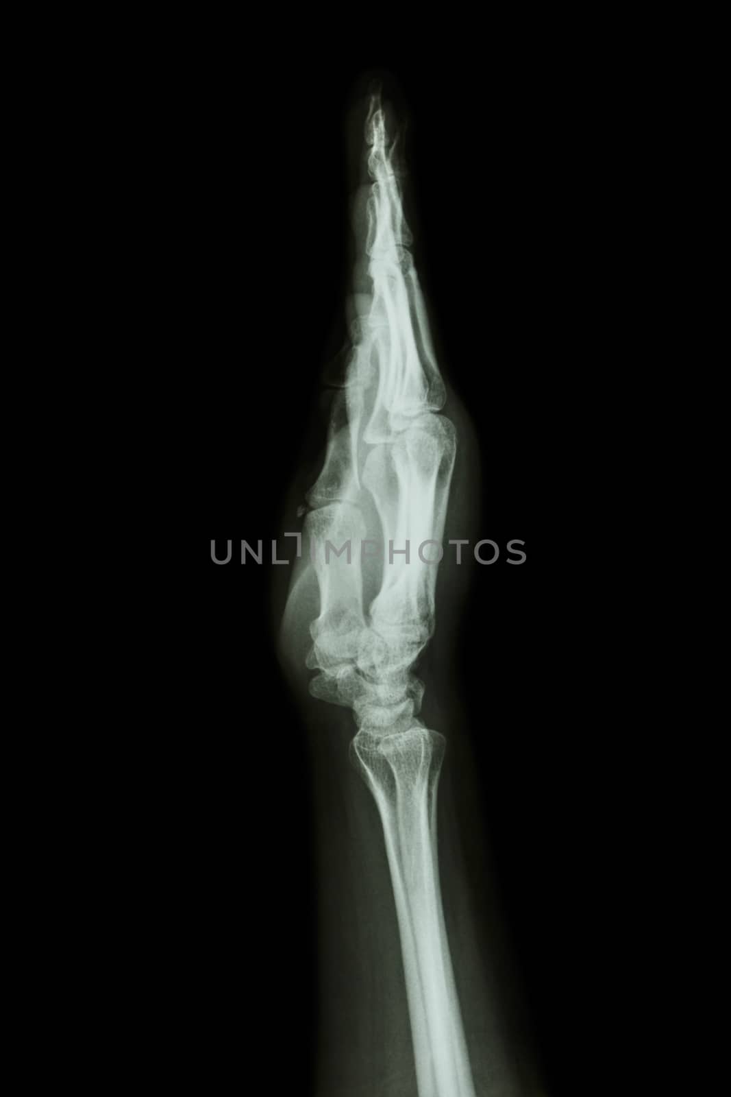 X-ray hand & forearm AP ( lateral ) ( side view )