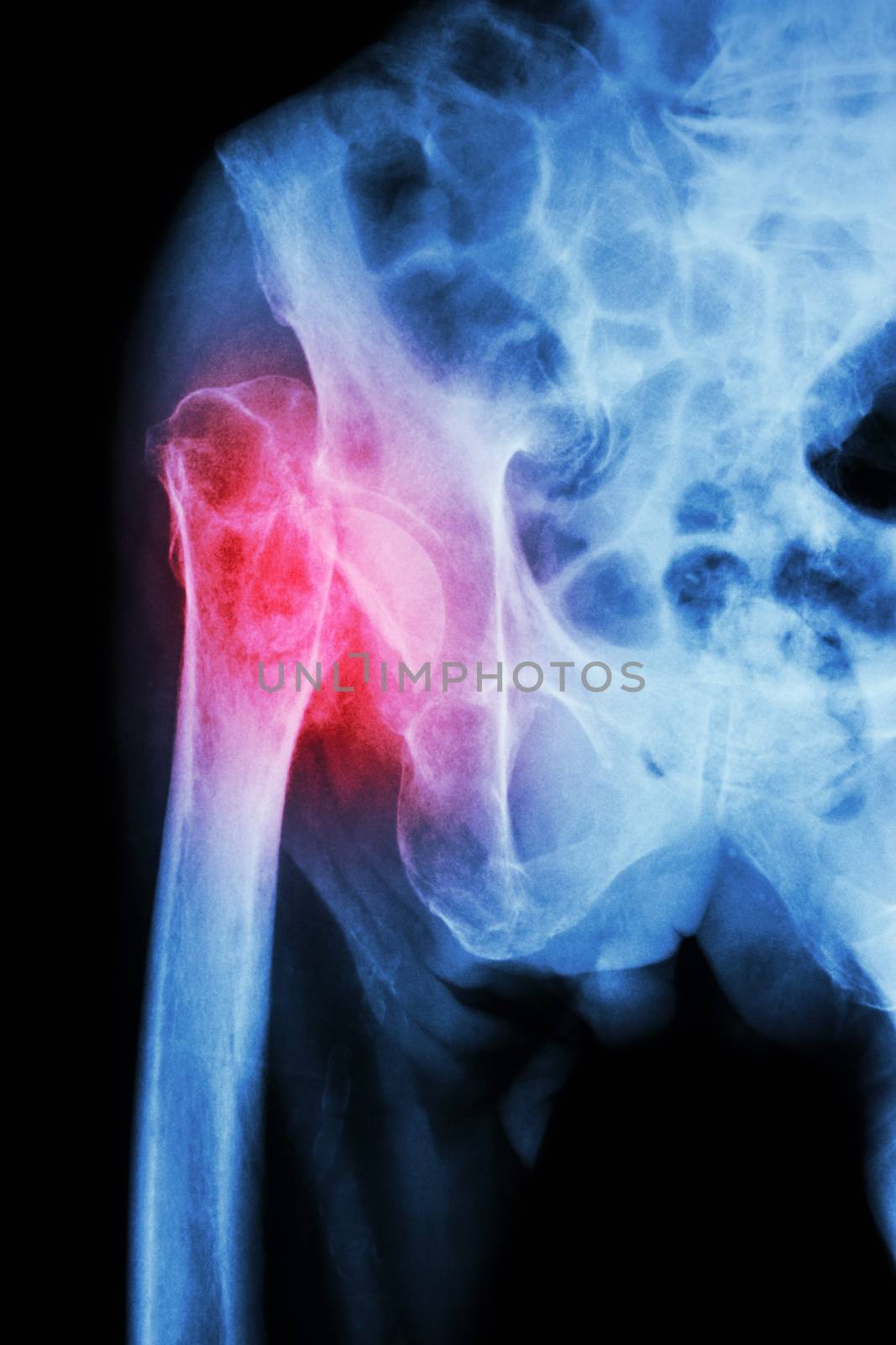 X-ray pelvis & hip joint : Fracture head of femur (thigh bone)
