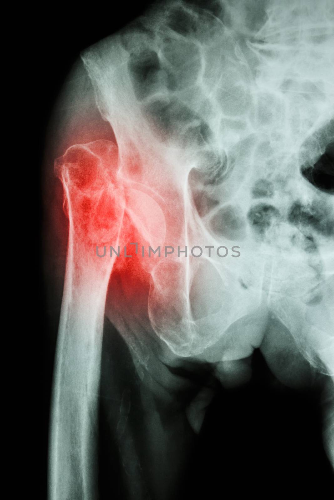 X-ray pelvis & hip joint : Fracture head of femur (thigh bone)