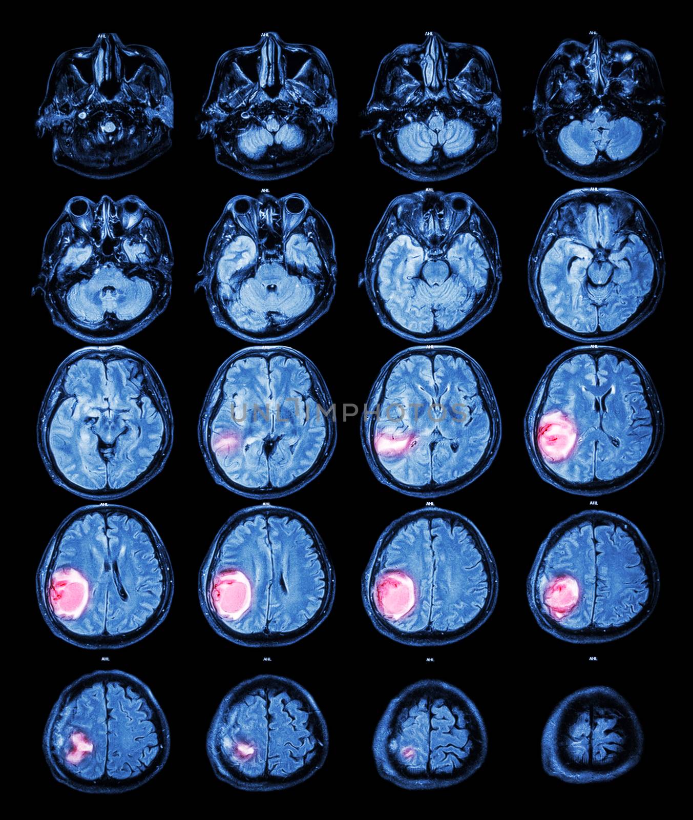 MRI brain : Brain tumor at right parietal lobe by stockdevil