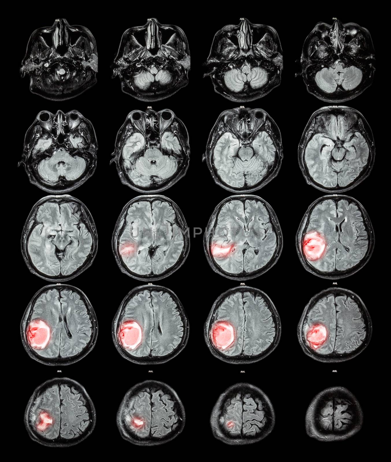 MRI brain : Brain tumor at right parietal lobe by stockdevil