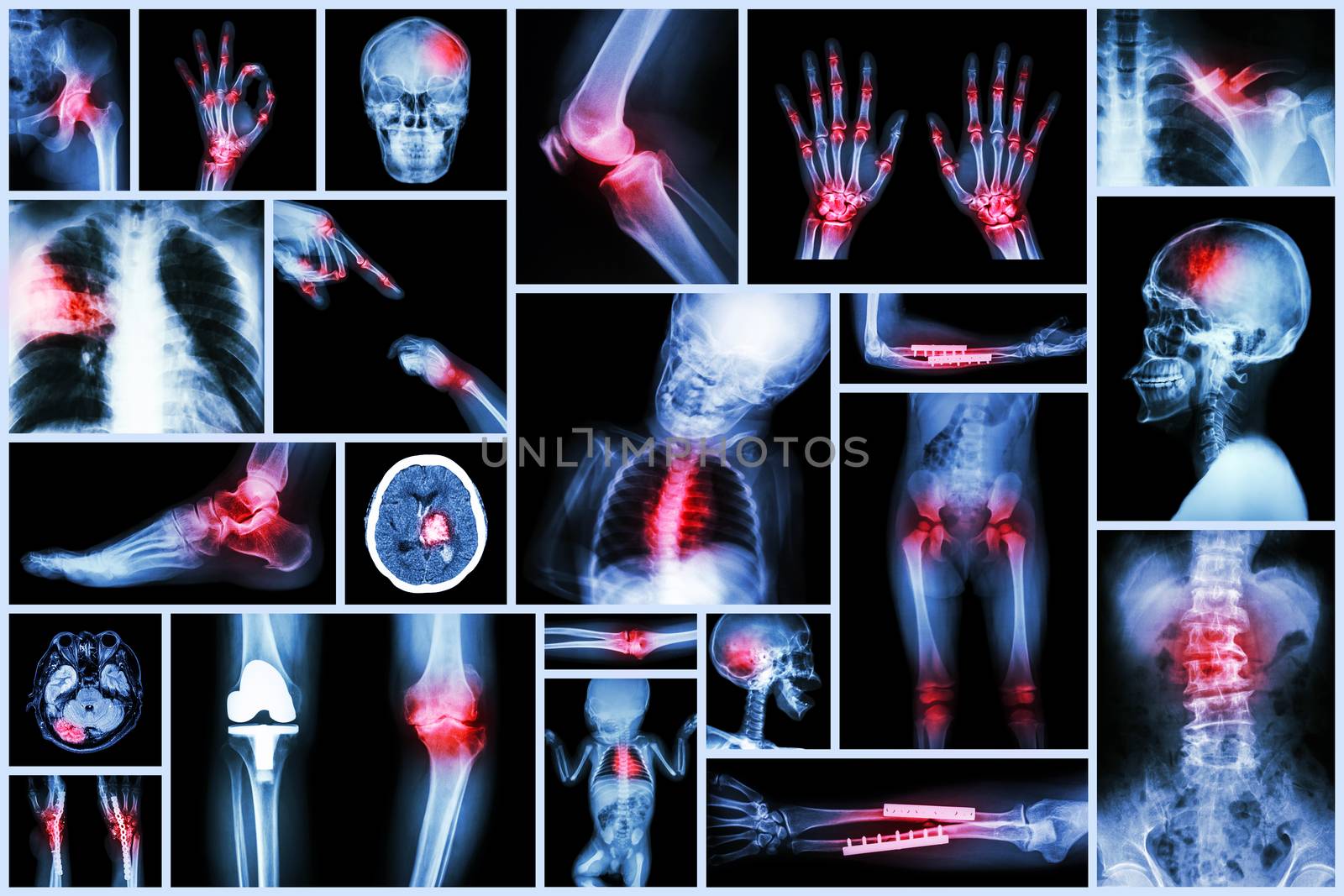 Collection X-ray multiple human's organ & orthopedic surgery & Multiple disease (Pulmonary tuberculosis , Gout , Rheumatoid arthritis ,Spondylosis , Fracture bone , Stroke , Brain tumor , etc) by stockdevil