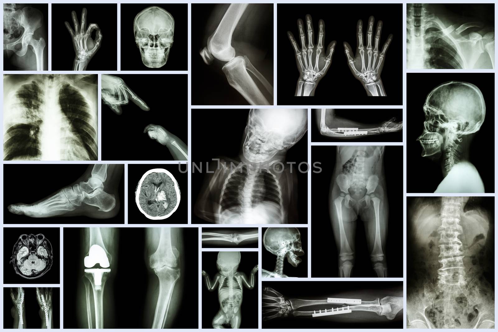 Collection X-ray multiple part of human & Orthopedic surgery & Multiple disease (Osteoarthritis knee,spondylosis,Stroke,Fracture bone,Pulmonary tuberculosis, etc) by stockdevil