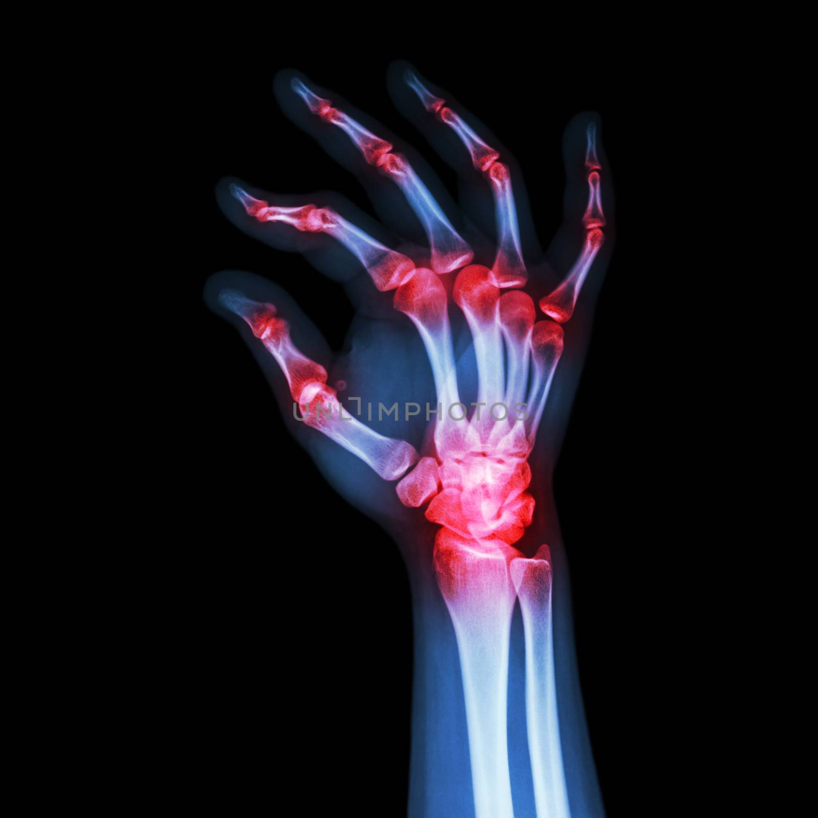 "Rheumatoid Arthritis , Gouty Arthritis" (X-ray adult's hand with multiple arthritis)