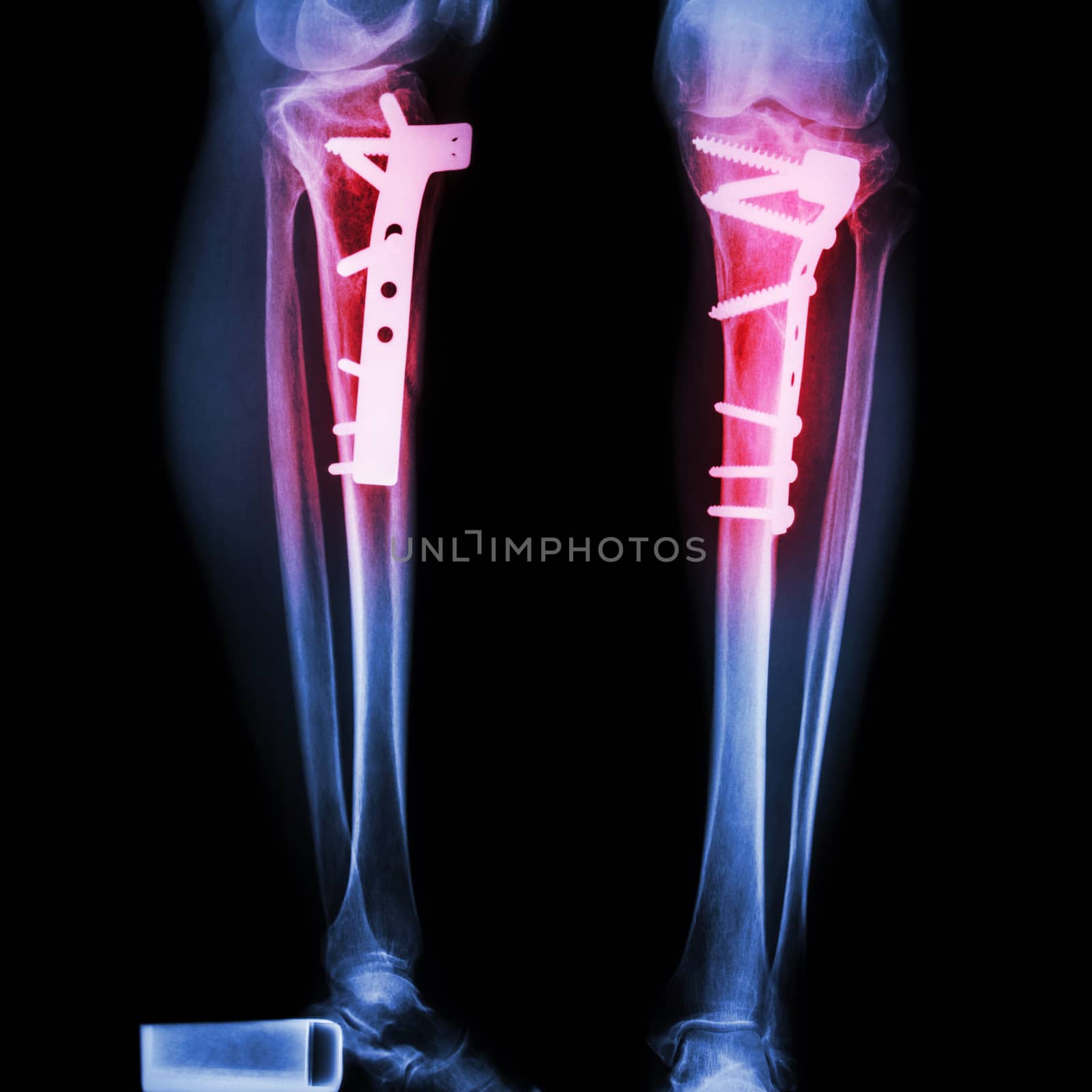 fracture tibia(leg bone) by stockdevil