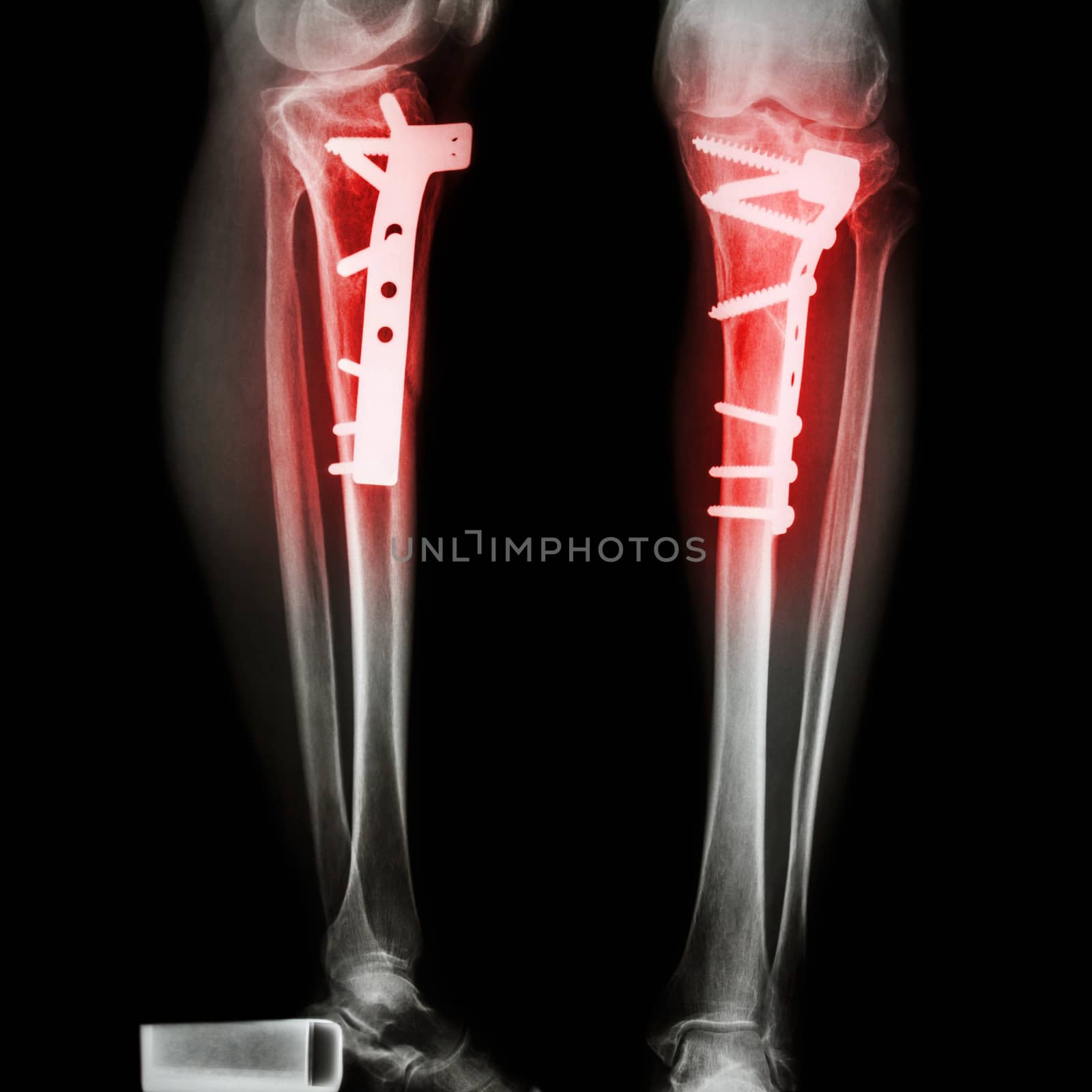 fracture tibia(leg bone) by stockdevil