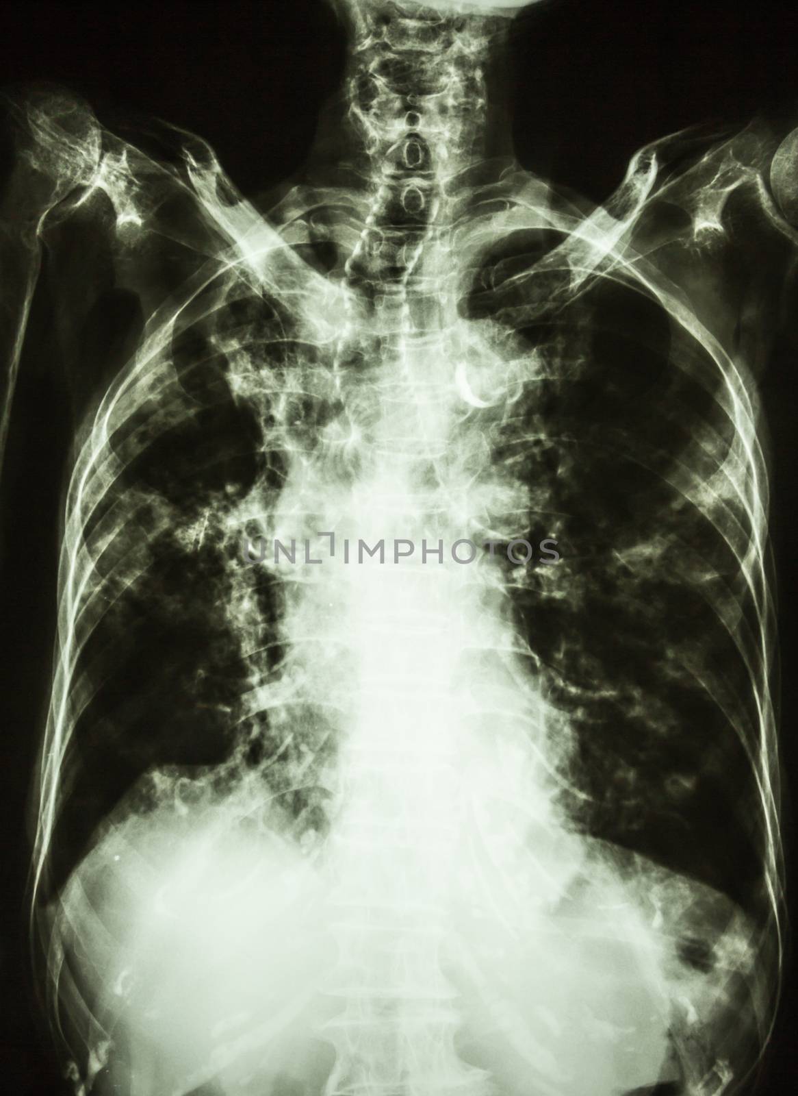 film chest X-ray PA upright of old patient : show interstitial infiltration both lung and calcification at trachea(can seen shape of trachea) due to mycobacterium tuberculosis infection (Pulmonary tuberculosis)