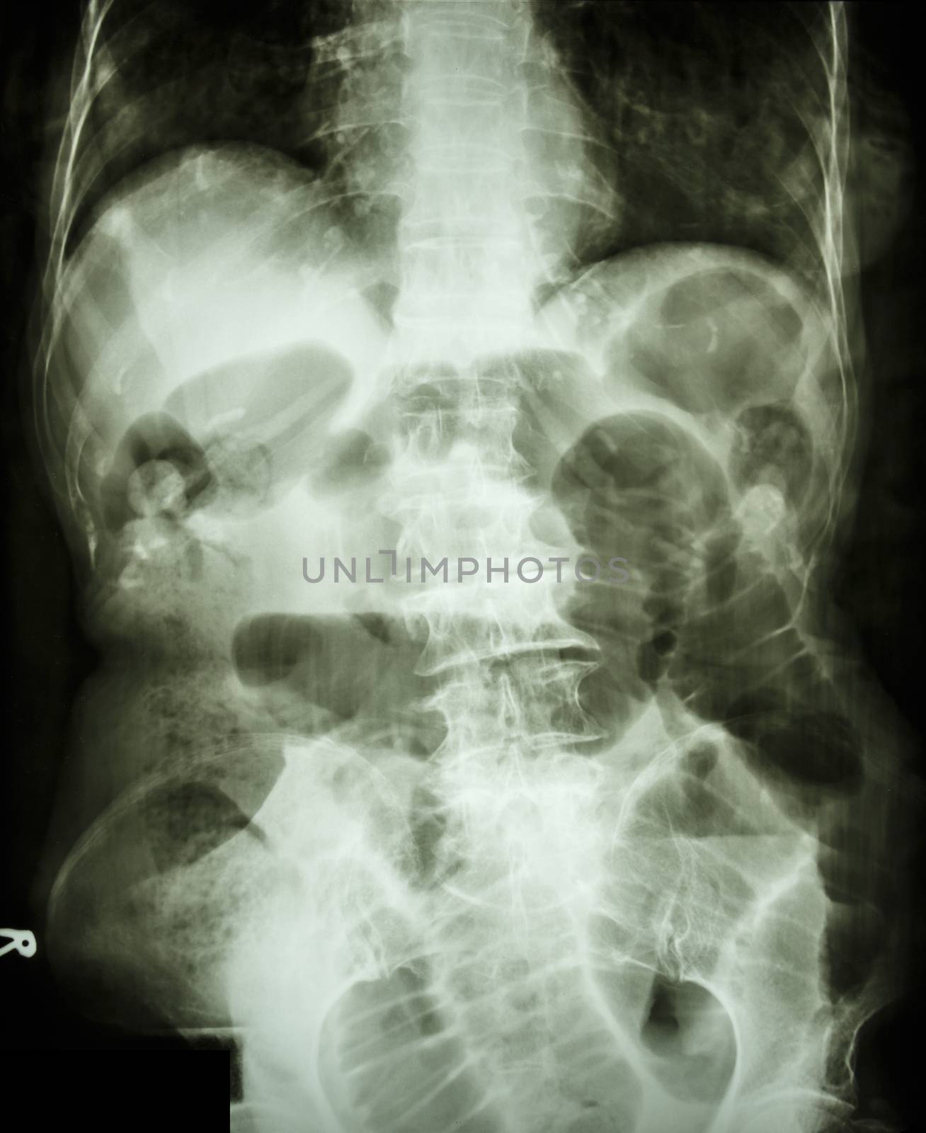 Film X-ray abdomen supine show small bowel dilated and air in small bowel due to small bowel obstruction