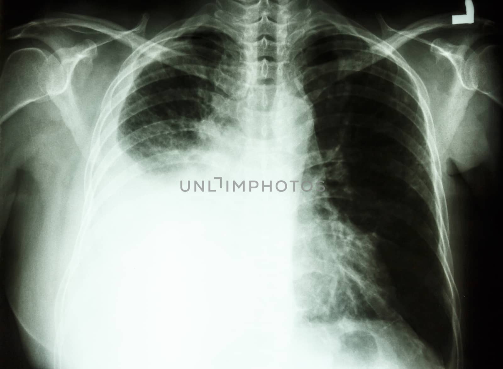 film chest X-ray PA upright : show pleural effusion at right lung due to lung cancer