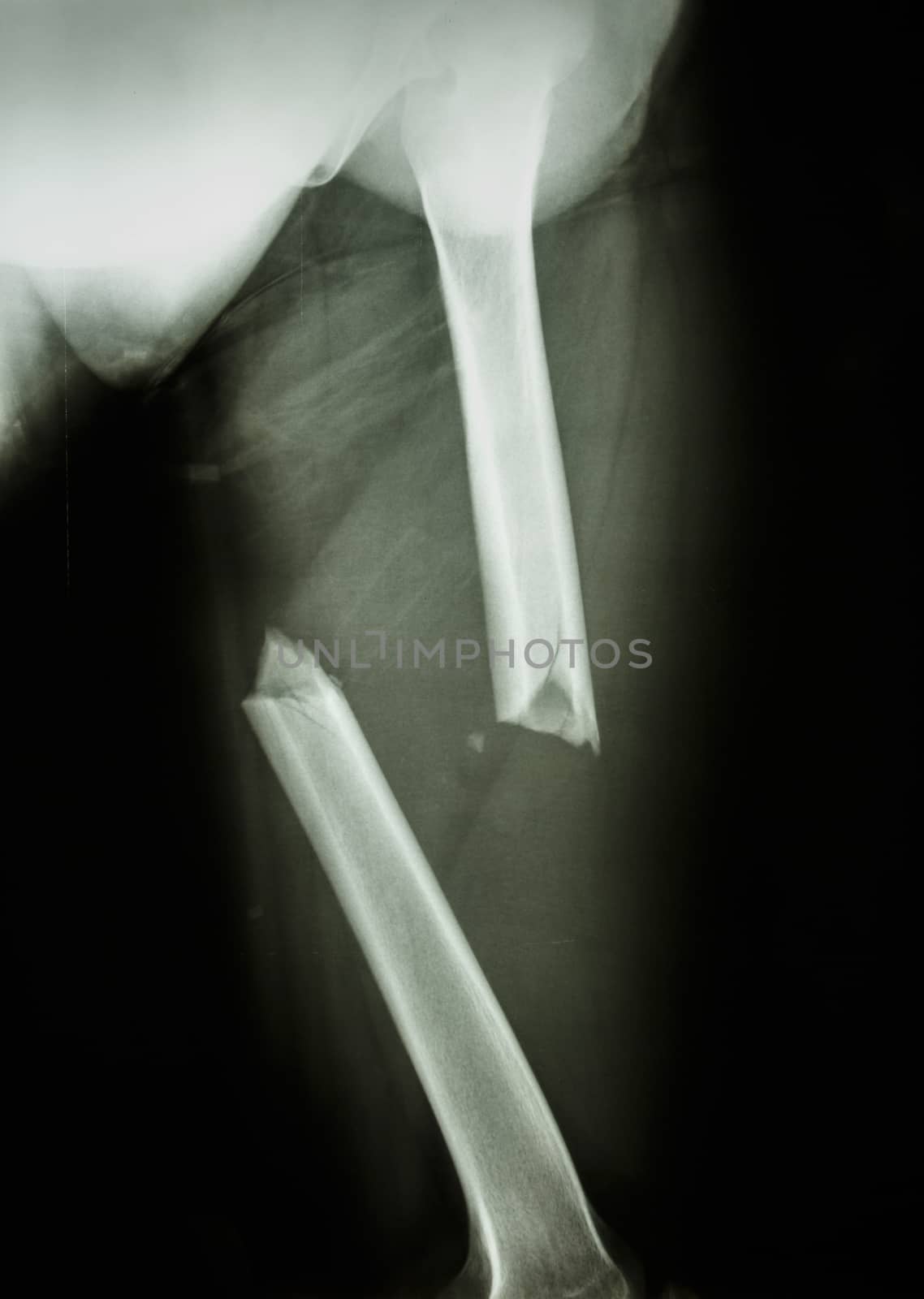 fracture femur by stockdevil