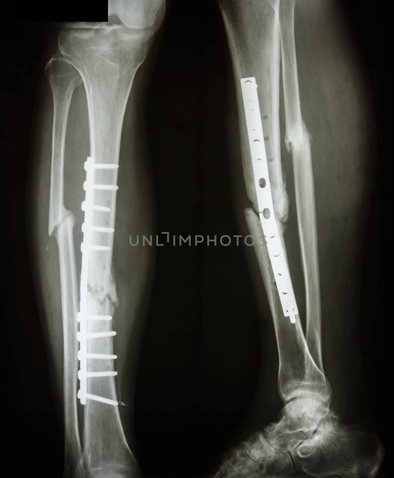 film leg AP/lateral : show fracture shaft of tibia and fibular (leg's bone). patient was operated and insert plate and screw for fix leg's bone