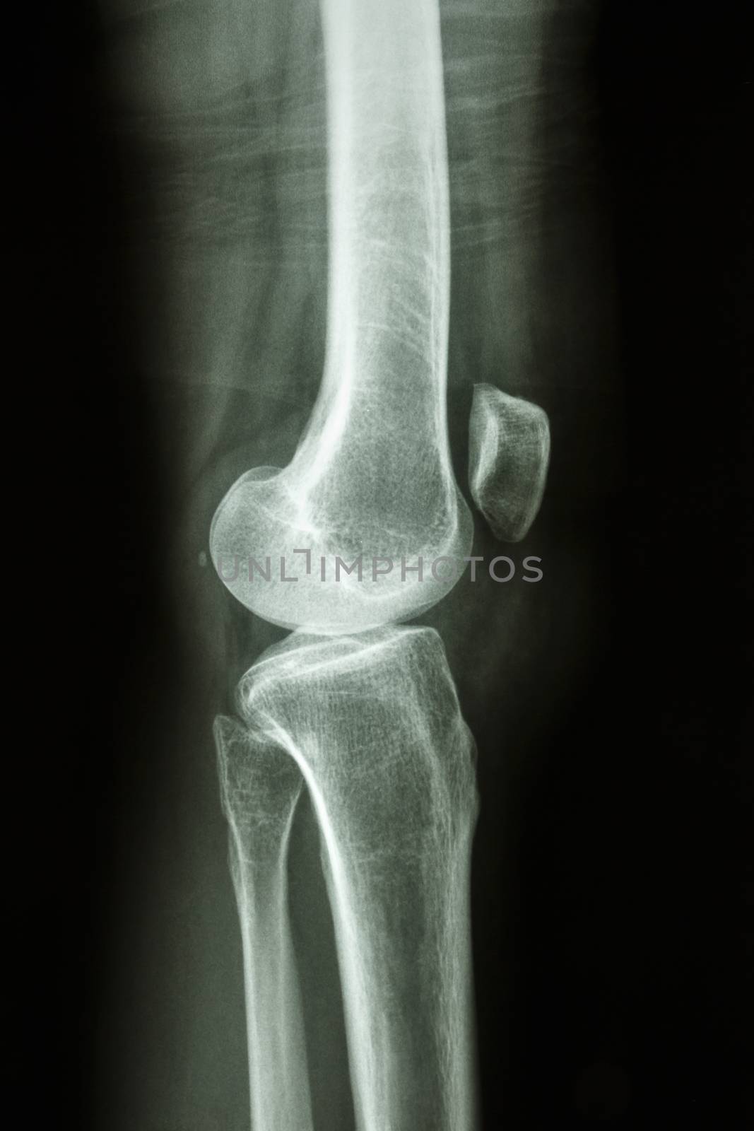 normal human's knee joint by stockdevil