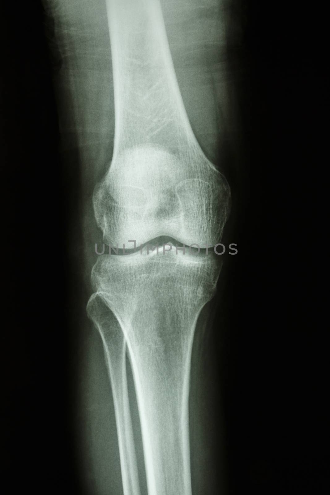 Flim X-ray knee AP : show normal human's knee joint