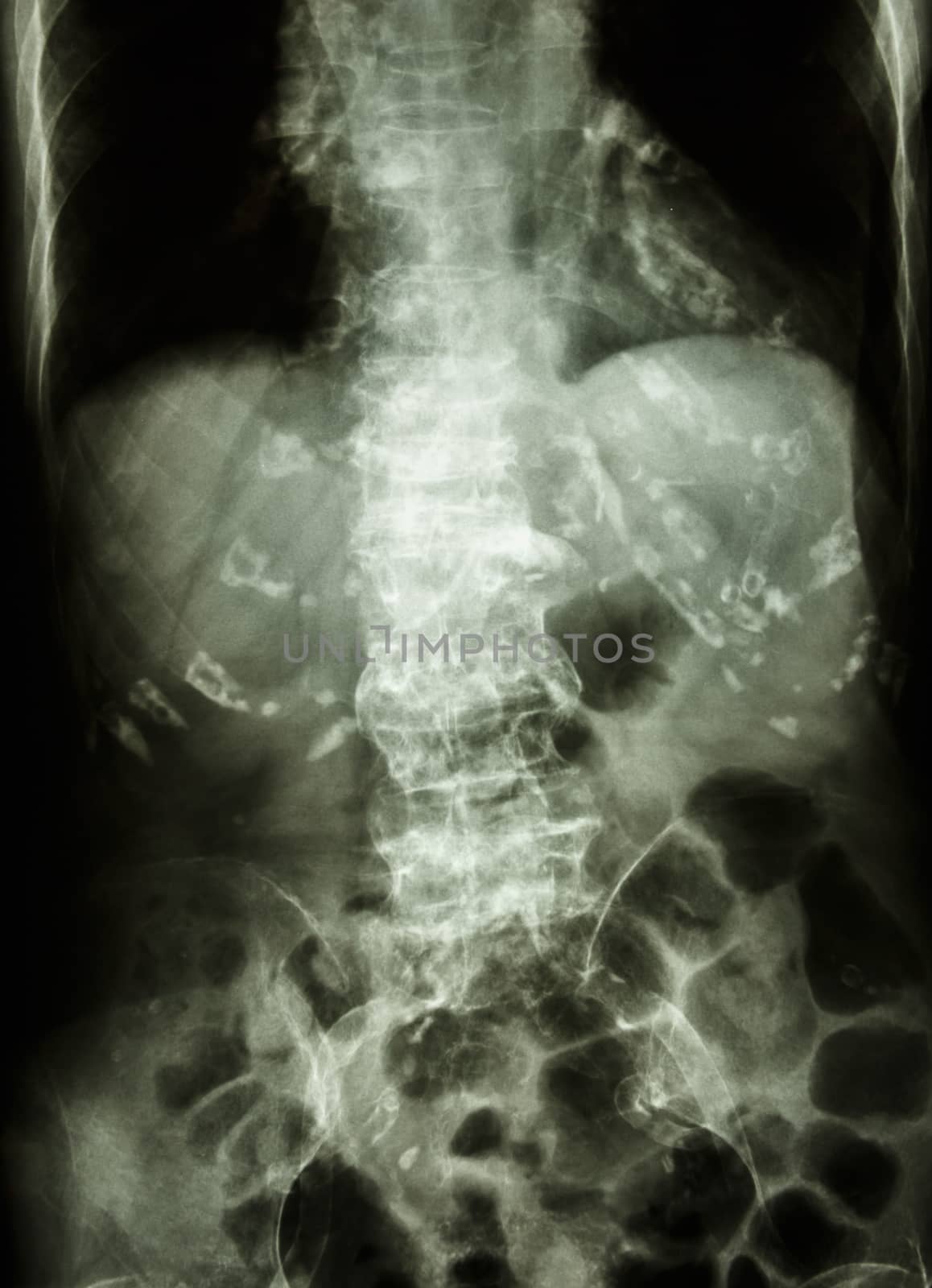 "Spondylosis" Film x-ray abdomen of old aged human : show spine with spur and calcification at multiple bone & vessels