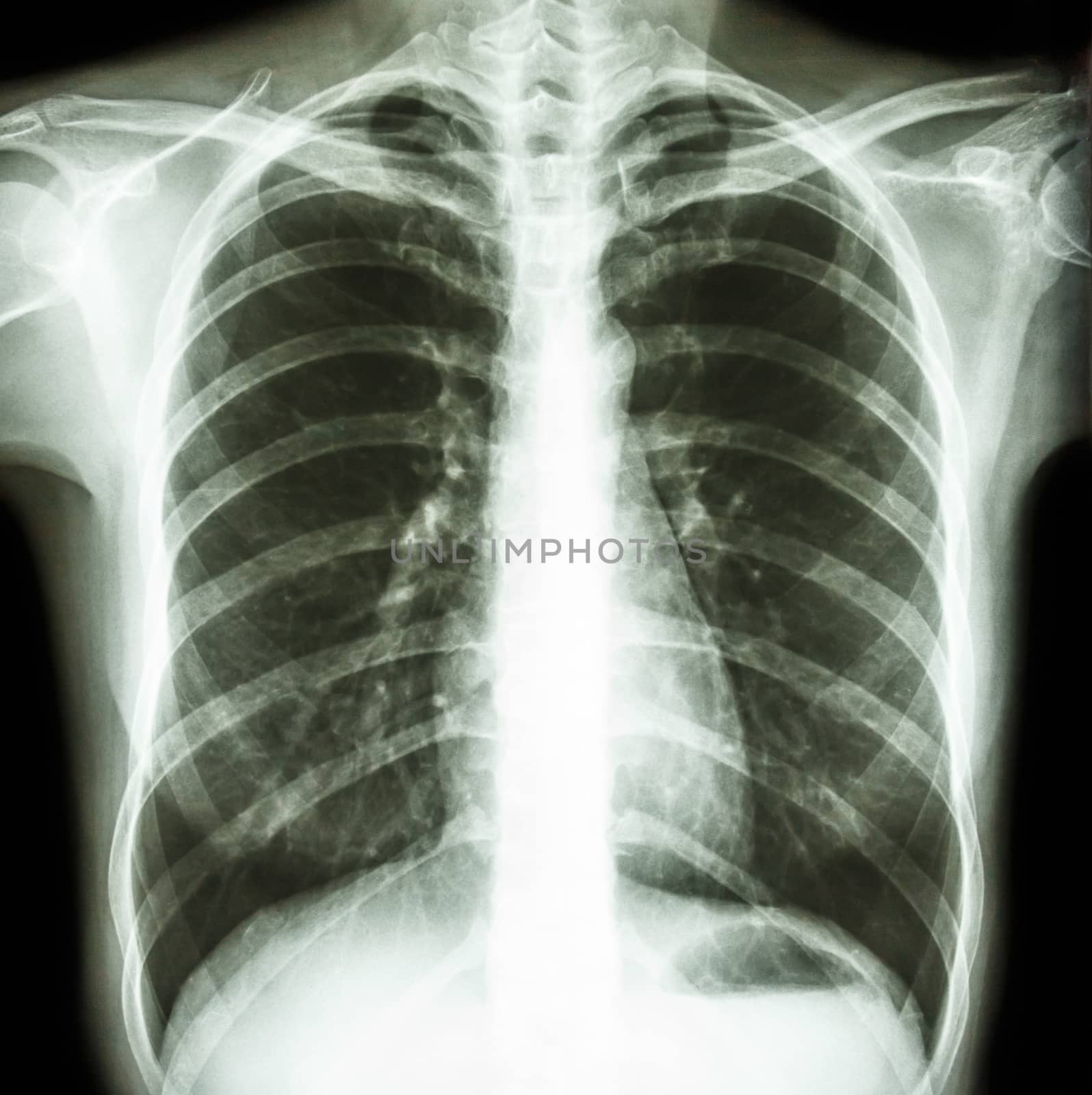 Film chest x-ray PA upright : show normal human's chest