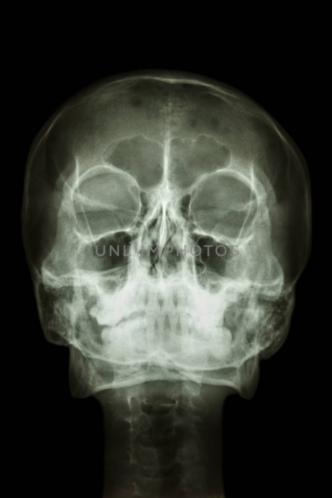 normal human's skull and cervical spine by stockdevil