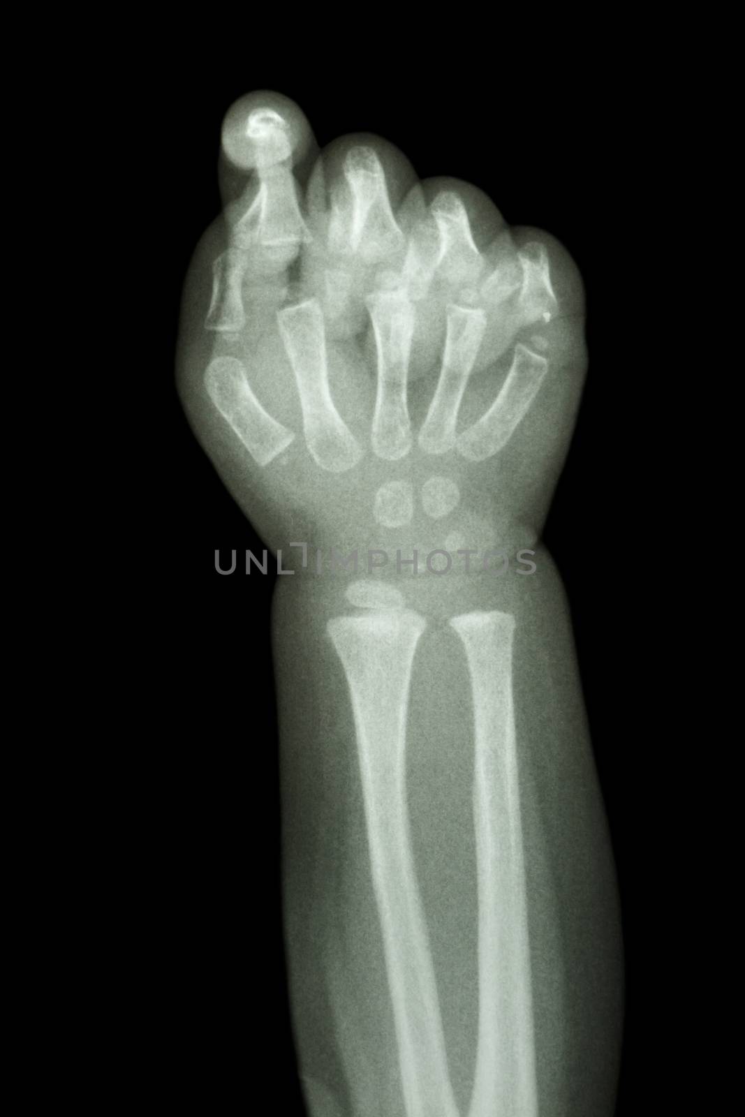 film x-ray forearm and hand : show normal infant's bone