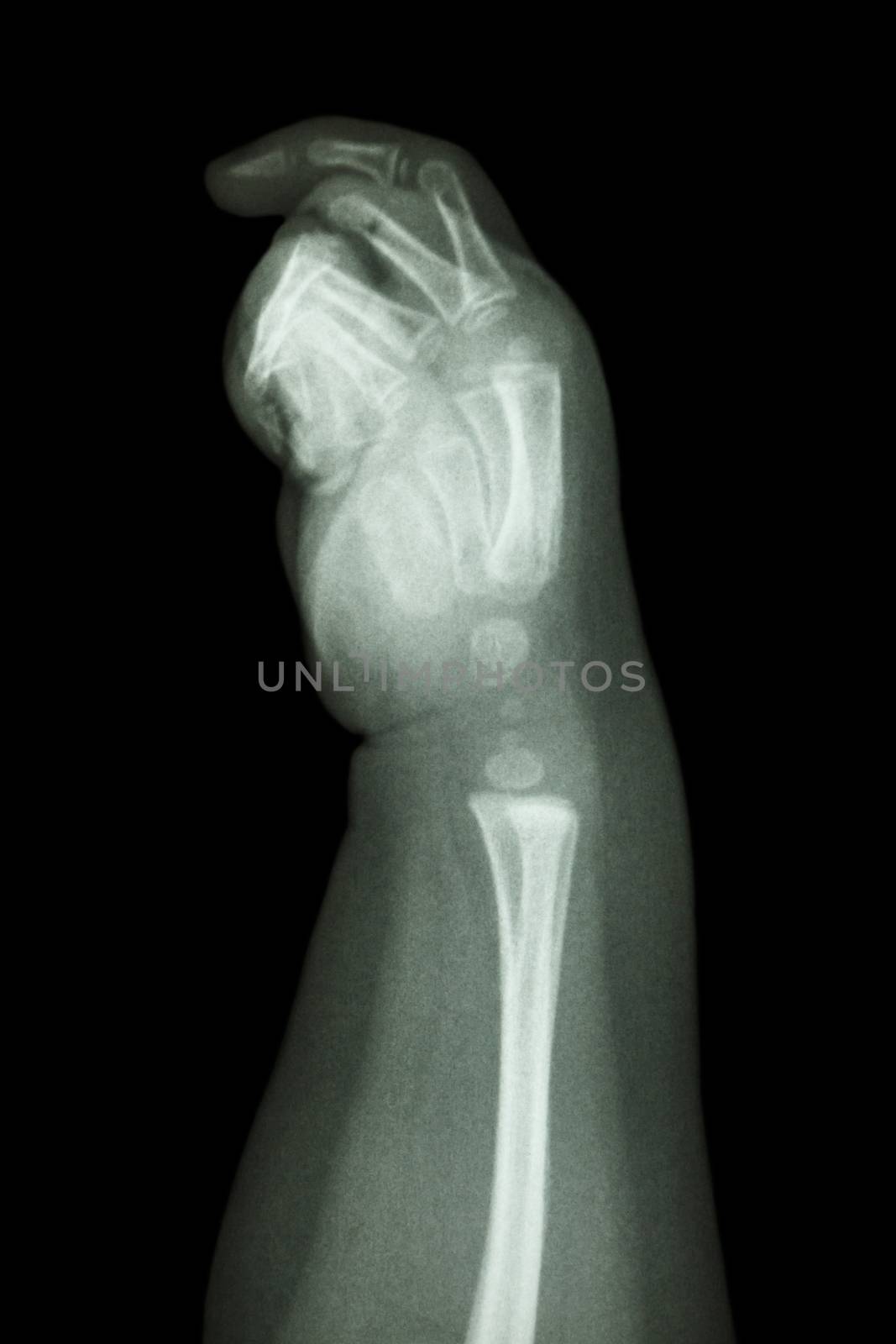 film x-ray forearm and hand : show normal infant's bone