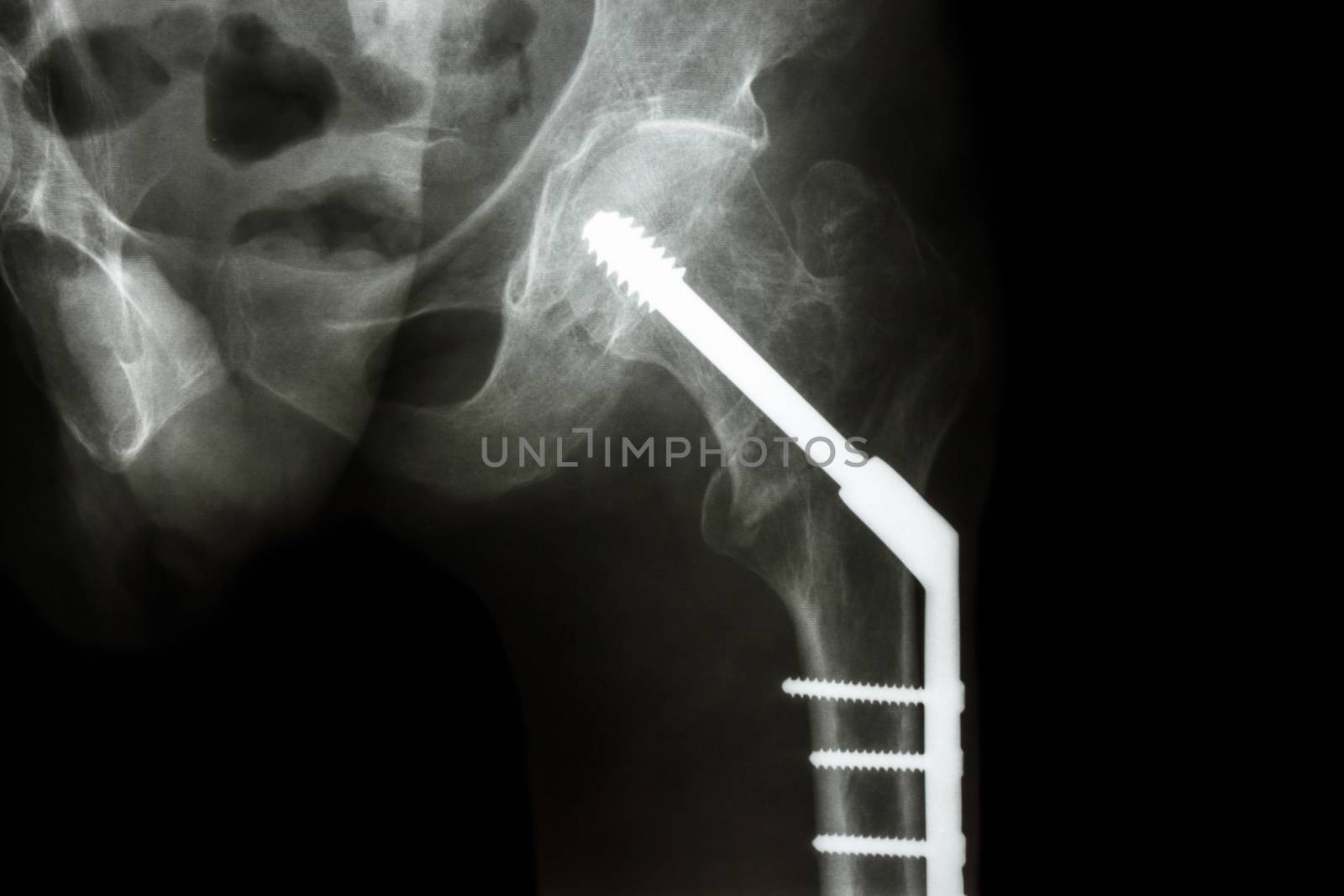 film x-ray left hip : show fracture neck of femur(thigh's bone). patient was operated and fixed bone by screw