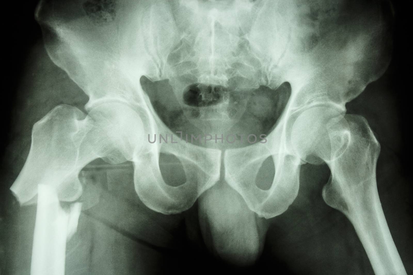 film x-ray pelvis AP : show fracture right femur (thigh's bone)