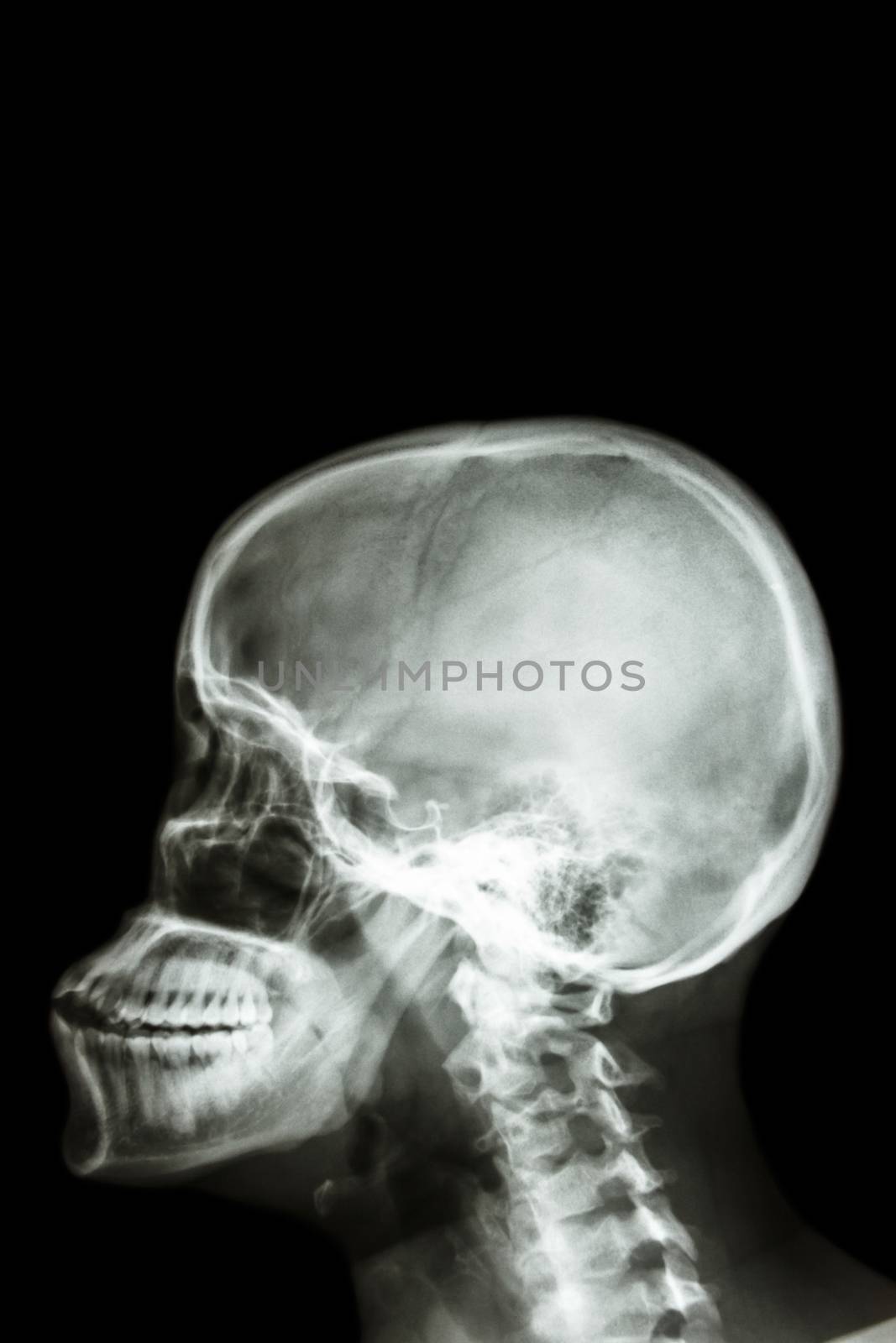 film x-ray skull lateral : show human's skull and blank area at upper side for fill text