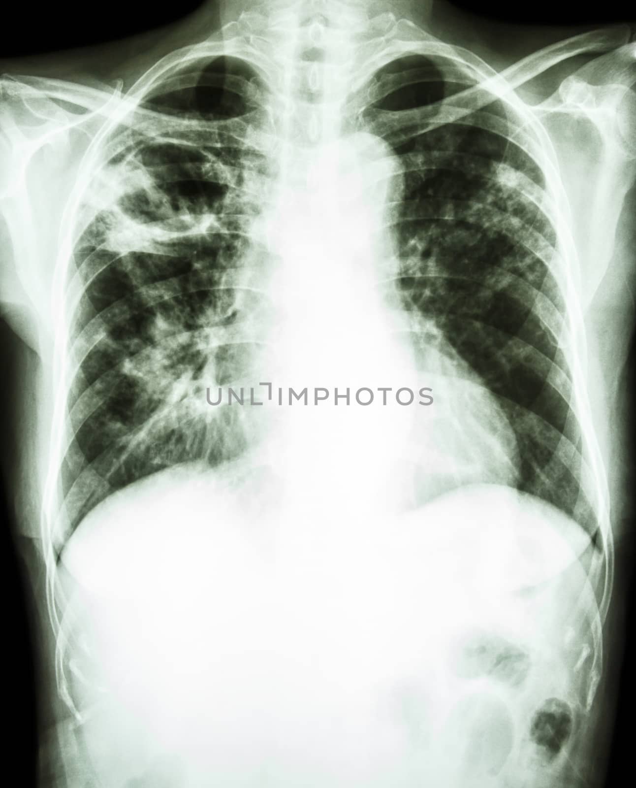 film chest x-ray show cavity at right upper lung due to Mycobacterium tuberculosis infection (Pulmonary Tuberculosis)