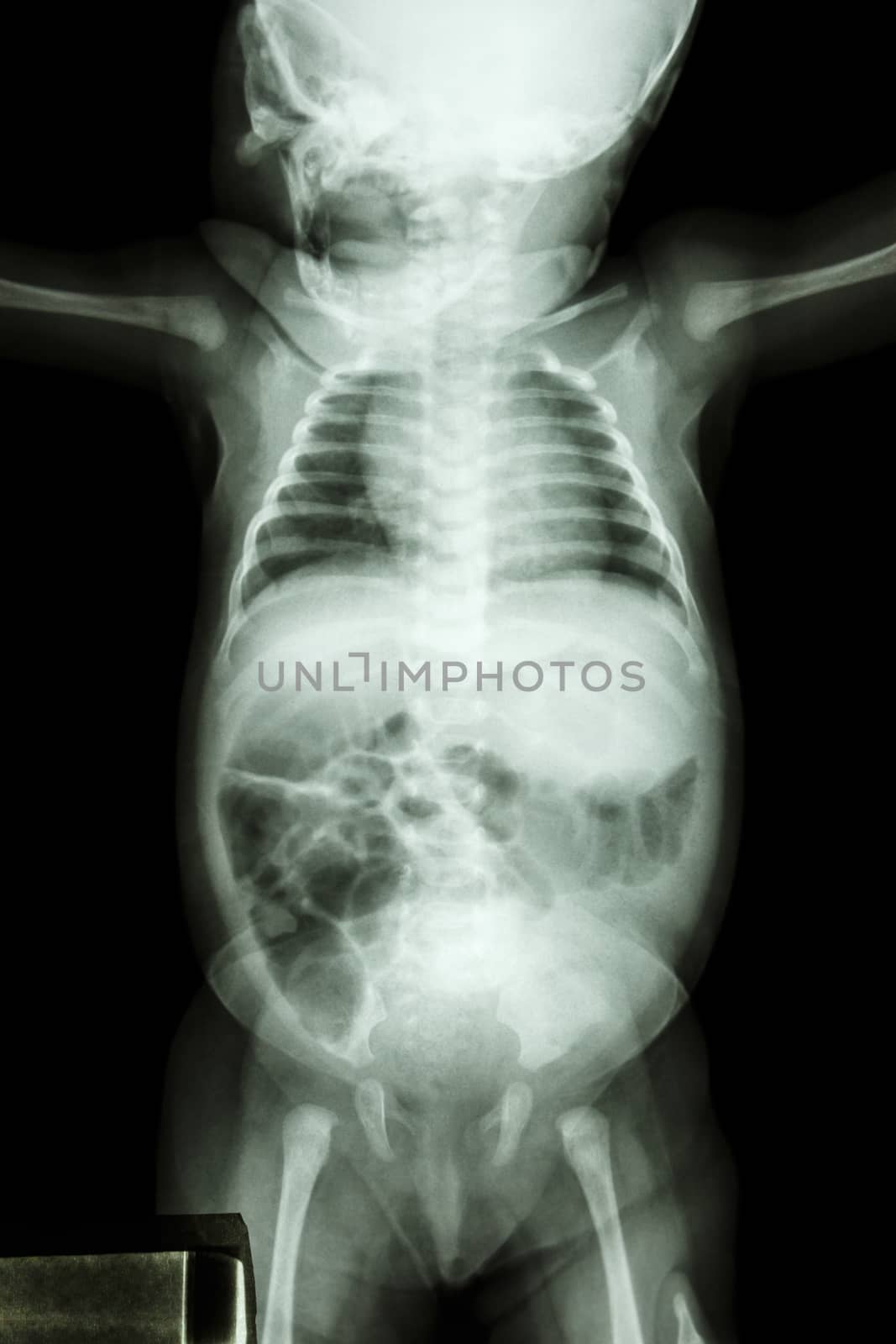 film x-ray whole infant's body by stockdevil